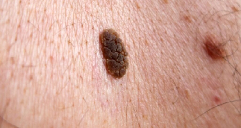 Everything To Know About Men And Melanoma